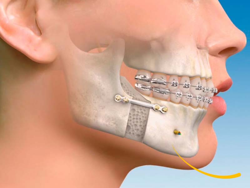 belledent-odontologia-especializada-dental-dentista-miraflores-lima-peru-especialidades-03002-cirugia-oral-y-maxilofacial