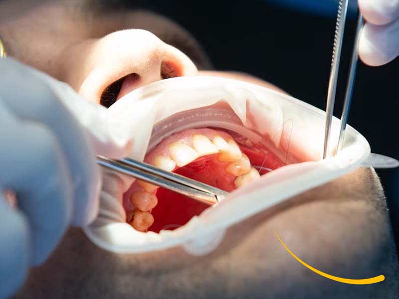 belledent-odontologia-especializada-dental-dentista-miraflores-lima-peru-especialidades-03007-cirugia-oral-y-maxilofacial